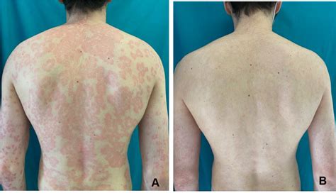 Latest Advances For The Treatment Of Chronic Plaque Psoriasis With