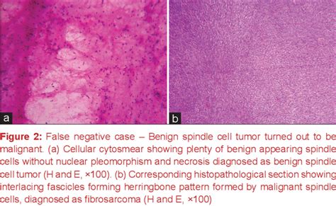 Figure 2 From Fine Needle Aspiration Cytology Of Soft Tissue Tumors With Its Histopathological