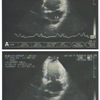 Two Dimensional Echocardiogram Left Ventricular Long Axis During