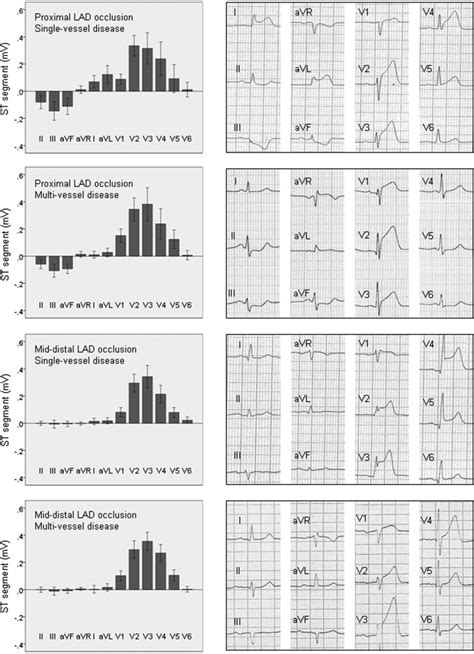 Electrocardiographic Changes Induced By Acute Occlusion Of The LAD