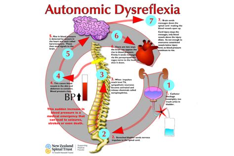 Autonomic Dysreflexia In Spinal Cord Injuries Reeve Off