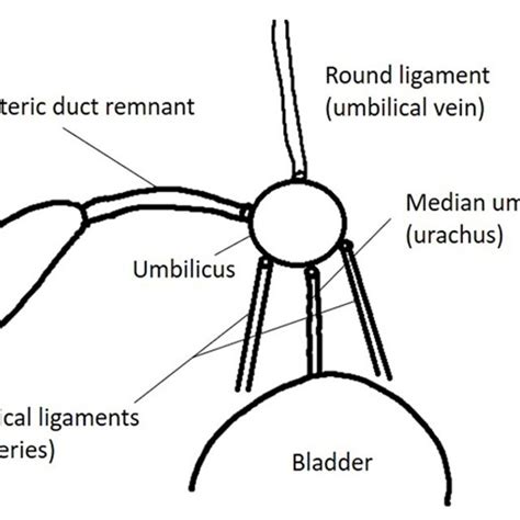 An umbilical polyp in an 11-month-old girl A. Transverse... | Download ...