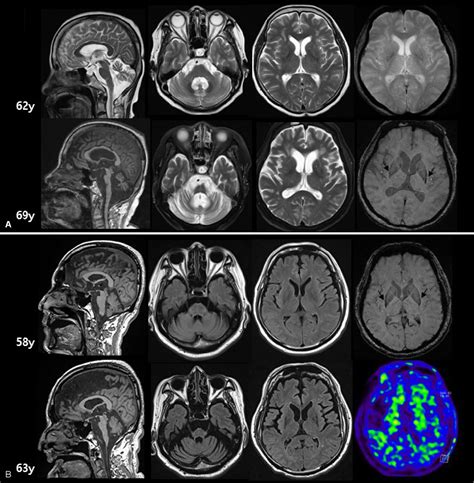 Figure 1 From Comparison Of Neuropathological Characteristics Between Multiple System Atrophy