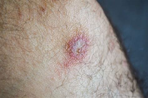 Leishmaniasis Cutánea Qué Es Síntomas Y Tratamiento Tua Saúde