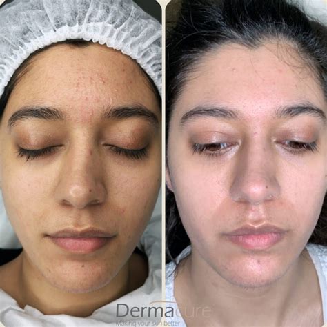 Green Peel Dr Schrammek Green Peel London Dermacure