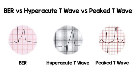 Peaked T Waves