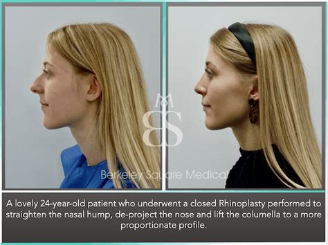 Rhinoplasty Nose Job In London UK Photos Cost FAQs