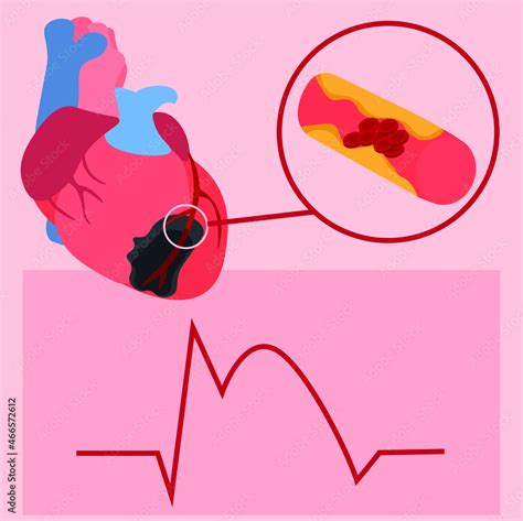 Heart Attack Illustration The Illustration Depicts Ecgs For Myocardial