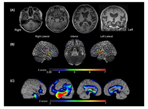 Brain Magnetic Resonance Imaging MRI Voxel Based Morphometry On