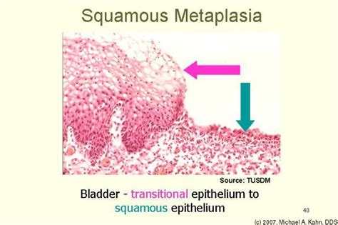 EXAMS AND ME : Metaplasia