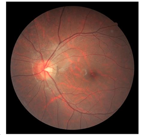 Fundus Photograph Obtained At 4 Months Post Onset Of Valsalva