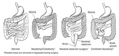 Ileostomy Diagram