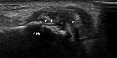 Injuries To The Collateral Ligaments Of The Metacarpophalangeal And