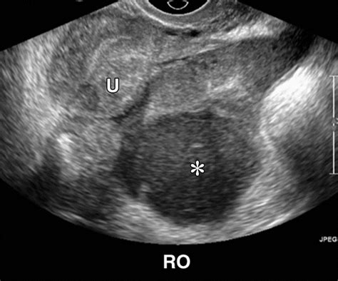 Imaging Evaluation Of Fallopian Tubes And Related Disease A Primer For Radiologists Radiographics