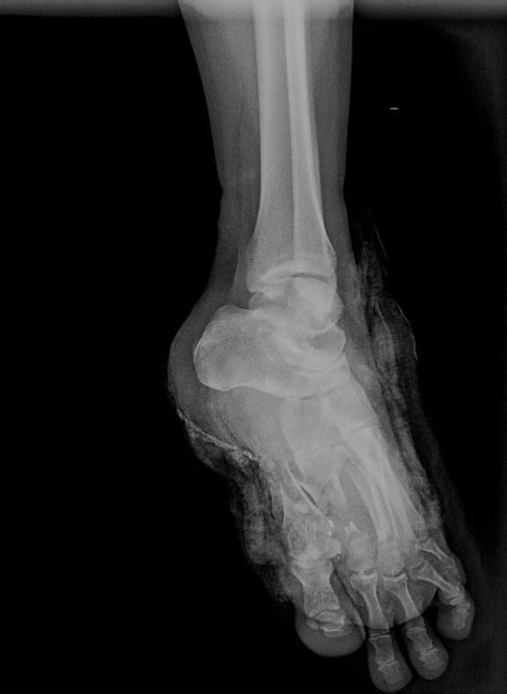 Lisfranc Fracture Dislocation With Multiple Associated Injuries Image