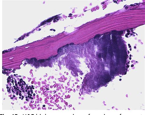 Figure 15 From Alveolar Osteitis And Osteomyelitis Of The Jaws