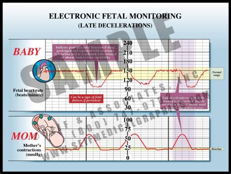 Efm Late Decelerations Sanda Medical Graphics