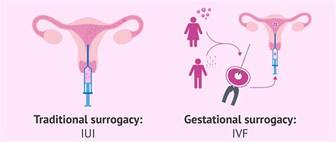 Traditional Surrogacy Vs Gestational Surrogacy India Ivf Fertility