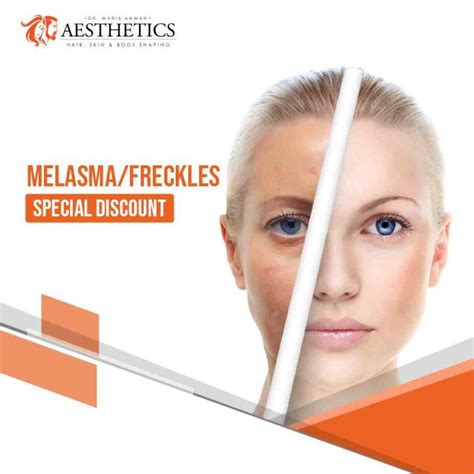 Melasma Treatment Dr Waris Anwar Aesthetics