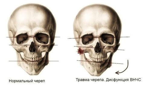 Перелом основи черепа - симптоми, перша допомога та лікування - Світ ...