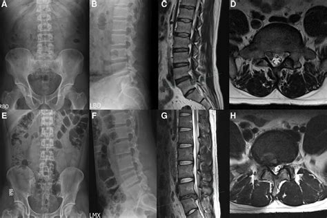 Two Patients With Lumbosacral Transitional Vertebrae A D A