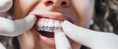 Is Invisalign Treatment Worth It A Comprehensive Guide To Find Out