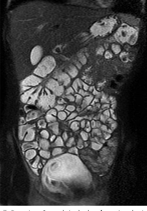 Figure From Imaging For Luminal Disease And Complications Ct