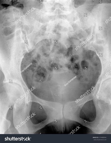 X Ray Hysterosalpingogram Hsg Stock Photo 219488944 | Shutterstock