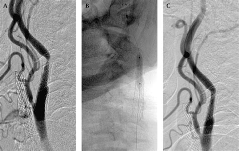 Results Of Cutting Balloon Angioplasty For Carotid Artery In Stent