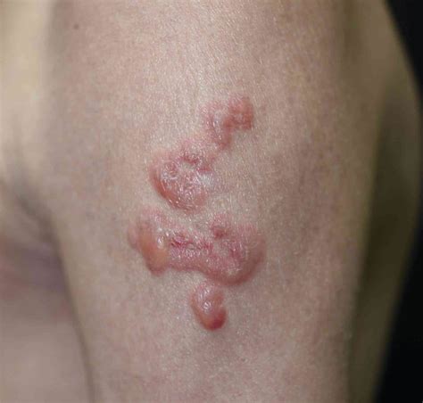 Linear IgA Bullous Dermatosis In Association With Crohn Disease Mayo