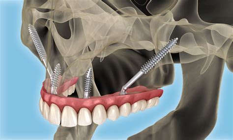 Zygomatic Implants Proclinix Dental Implant Centre