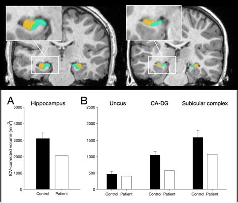 Manual segmentation of the hippocampus. Top: 3T-MRI scan of a ...