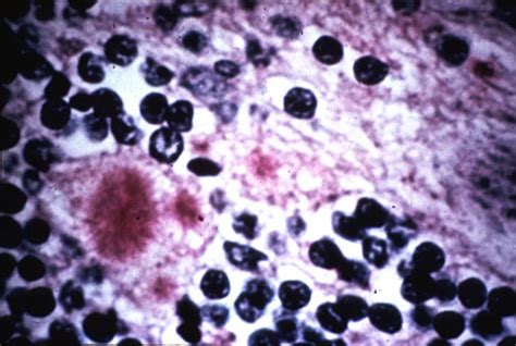 Diseases Kuru Disease