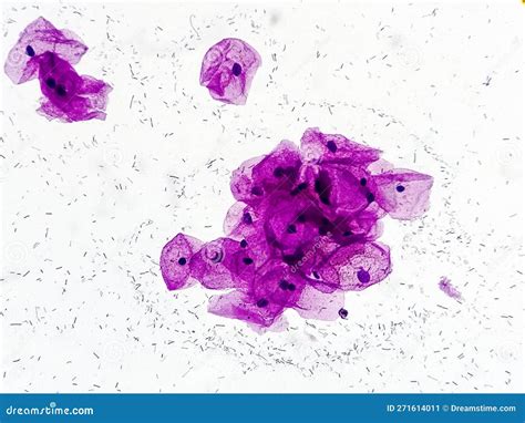 Pap S Smear Microscopic Showing Severe Inflammatory Epithelial Cells