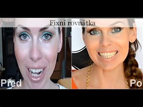 Fixní rovnátka, moje zkušenosti, stav po sundání - YouTube