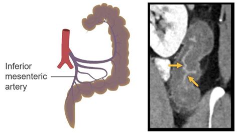 Abdominal CT Enteritis And Colitis LITFL Radiology Library