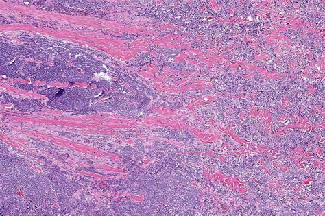 Pathology Outlines Merkel Cell Carcinoma