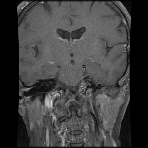 Meningiomas Cavernous Sinus And Temporal Image Radiopaedia Org Hot