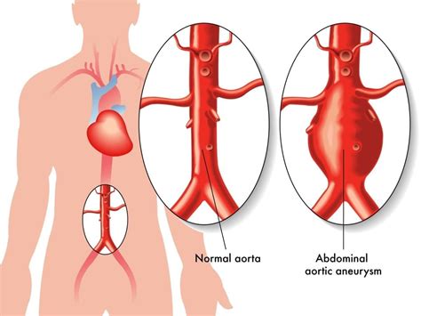 What is an Aneurysm? | PBworks