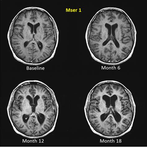 Multiple Sclerosis Research: End-organ damage: MRI grey matter atrophy ...