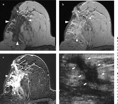 Multimodality Imaging Features Of Idiopathic Granulomatous Mastitis