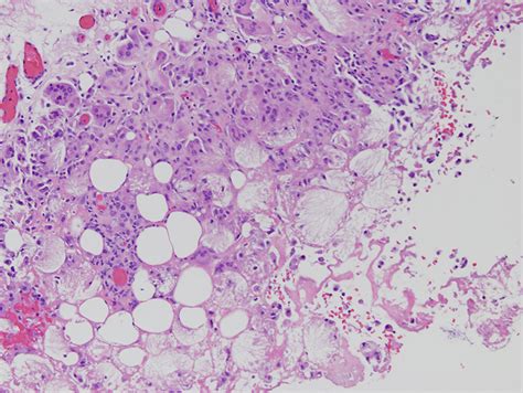 Subcutaneous Fat Necrosis Of The Newborn Dermatopathology