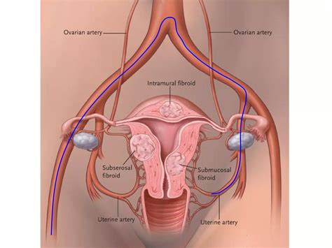 Uterine Artery Embolisation Ppt