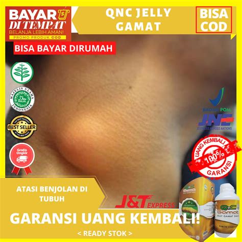 Jual Obat Benjolan Di Leher Di Ketiak Payudara Benjoan Kelenjar