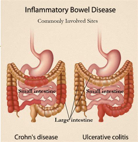 Ibd