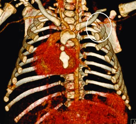 Preoperative Ct Chest Angiography A D Reconstruction Of Major Chest Images