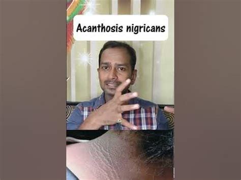 Acanthosis nigricans| First sign of Diabetes & PCOS| Day 58/100| # ...