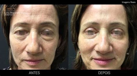 45 Fotos De Blefaroplastia Antes E Depois Do Procedimento