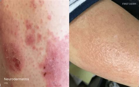 Heat Rash Vs Eczema How To Tell The Difference First Derm