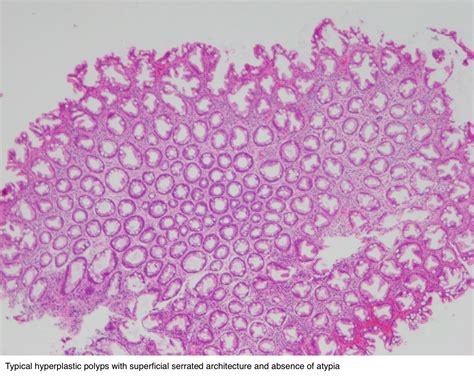 Pathology Outlines Hyperplastic Polyp